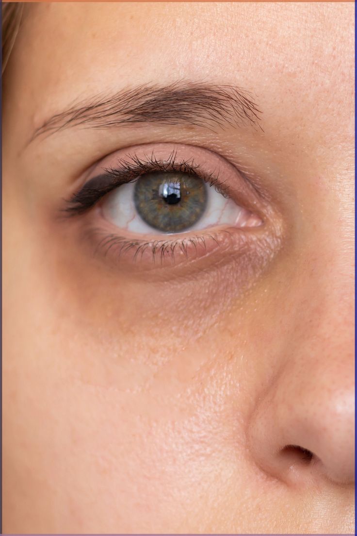 DARK CIRCLES